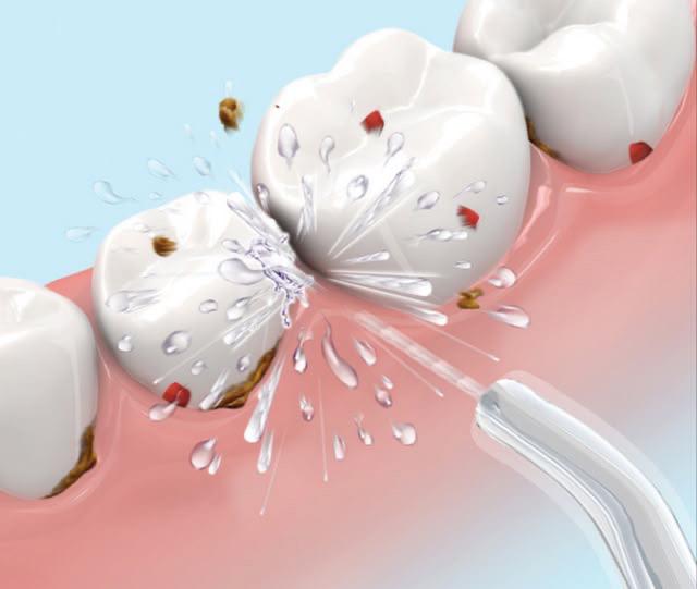 HydroSmile: el irrigador bucal que transformará tu sonrisa